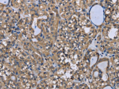 The image on the left is immunohistochemistry of paraffin-embedded Human thyroid cancer tissue using CSB-PA177666(FOXO1 Antibody) at dilution 1/20, on the right is treated with synthetic peptide. (Original magnification: ×200)