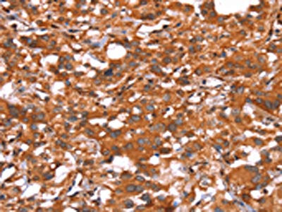 The image on the left is immunohistochemistry of paraffin-embedded Human thyroid cancer tissue using CSB-PA177709(GLS Antibody) at dilution 1/15, on the right is treated with synthetic peptide. (Original magnification: ×200)