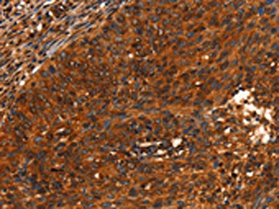 The image on the left is immunohistochemistry of paraffin-embedded Human cervical cancer tissue using CSB-PA177777(PRKD1 Antibody) at dilution 1/40, on the right is treated with synthetic peptide. (Original magnification: ×200)
