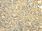 The image on the left is immunohistochemistry of paraffin-embedded Human breast cancer tissue using CSB-PA177790(SDHA Antibody) at dilution 1/40, on the right is treated with fusion protein. (Original magnification: ×200)