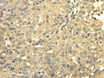 The image on the left is immunohistochemistry of paraffin-embedded Human breast cancer tissue using CSB-PA177790(SDHA Antibody) at dilution 1/40, on the right is treated with fusion protein. (Original magnification: ×200)