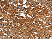 The image on the left is immunohistochemistry of paraffin-embedded Human thyroid cancer tissue using CSB-PA177791(CR1 Antibody) at dilution 1/25, on the right is treated with synthetic peptide. (Original magnification: ×200)