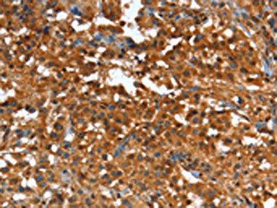 The image on the left is immunohistochemistry of paraffin-embedded Human thyroid cancer tissue using CSB-PA177791(CR1 Antibody) at dilution 1/25, on the right is treated with synthetic peptide. (Original magnification: ×200)
