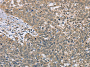 The image on the left is immunohistochemistry of paraffin-embedded Human cervical cancer tissue using CSB-PA177824(DACH2 Antibody) at dilution 1/40, on the right is treated with fusion protein. (Original magnification: ×200)