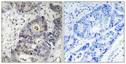 Immunohistochemical analysis of paraffin-embedded human colon carcinoma tissue using Inos (Phospho-Tyr151) antibody (left)or the same antibody preincubated with blocking peptide (right).