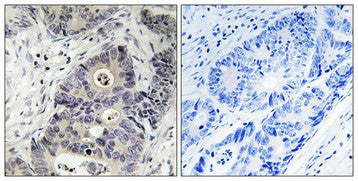Immunohistochemical analysis of paraffin-embedded human colon carcinoma tissue using Inos (Phospho-Tyr151) antibody (left)or the same antibody preincubated with blocking peptide (right).
