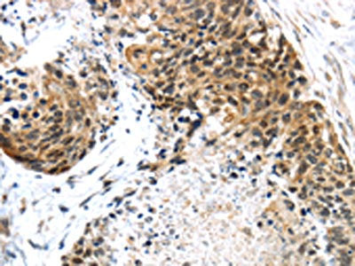 The image on the left is immunohistochemistry of paraffin-embedded Human esophagus cancer tissue using CSB-PA178293(TRIM74 Antibody) at dilution 1/45, on the right is treated with fusion protein. (Original magnification: ×200)