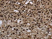 The image on the left is immunohistochemistry of paraffin-embedded Human esophagus cancer tissue using CSB-PA178639(ANP32E Antibody) at dilution 1/20, on the right is treated with synthetic peptide. (Original magnification: ×200)