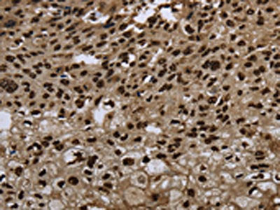 The image on the left is immunohistochemistry of paraffin-embedded Human esophagus cancer tissue using CSB-PA178639(ANP32E Antibody) at dilution 1/20, on the right is treated with synthetic peptide. (Original magnification: ×200)