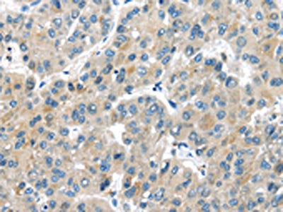 The image on the left is immunohistochemistry of paraffin-embedded Human liver cancer tissue using CSB-PA178736(MASP2 Antibody) at dilution 1/35, on the right is treated with synthetic peptide. (Original magnification: ×200)