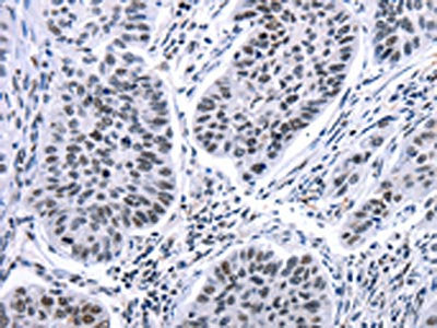 The image on the left is immunohistochemistry of paraffin-embedded Human lung cancer tissue using CSB-PA178769(HSPB2 Antibody) at dilution 1/5, on the right is treated with fusion protein. (Original magnification: ×200)