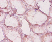 Immunohistochemistry of paraffin-embedded human colon cancer using CSB-PA17884A0Rb at dilution of 1:20