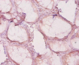 Immunohistochemistry of paraffin-embedded human colon cancer using CSB-PA17884A0Rb at dilution of 1:20