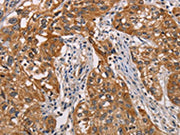 The image on the left is immunohistochemistry of paraffin-embedded Human esophagus cancer tissue using CSB-PA178887(CRYAB Antibody) at dilution 1/25, on the right is treated with fusion protein. (Original magnification: ×200)