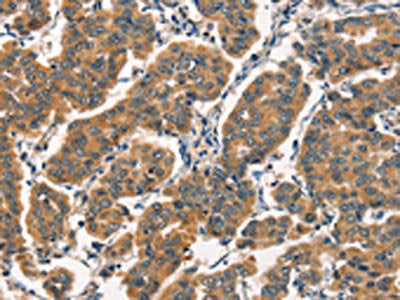 The image on the left is immunohistochemistry of paraffin-embedded Human breast cancer tissue using CSB-PA178890(ARL6IP1 Antibody) at dilution 1/30, on the right is treated with fusion protein. (Original magnification: ×200)