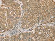 The image on the left is immunohistochemistry of paraffin-embedded Human ovarian cancer tissue using CSB-PA178912(DMRT3 Antibody) at dilution 1/50, on the right is treated with fusion protein. (Original magnification: ×200)