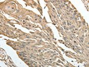 The image on the left is immunohistochemistry of paraffin-embedded Human cervical cancer tissue using CSB-PA179036(HSP90B1 Antibody) at dilution 1/30, on the right is treated with fusion protein. (Original magnification: ×200)