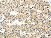 The image on the left is immunohistochemistry of paraffin-embedded Human liver cancer tissue using CSB-PA179135(WDR36 Antibody) at dilution 1/35, on the right is treated with synthetic peptide. (Original magnification: ×200)