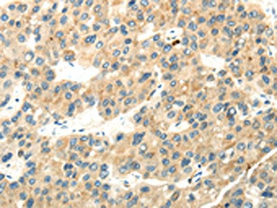 The image on the left is immunohistochemistry of paraffin-embedded Human liver cancer tissue using CSB-PA179135(WDR36 Antibody) at dilution 1/35, on the right is treated with synthetic peptide. (Original magnification: ×200)