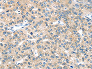 The image on the left is immunohistochemistry of paraffin-embedded Human liver cancer tissue using CSB-PA179150(EPHA2 Antibody) at dilution 1/20, on the right is treated with synthetic peptide. (Original magnification: ×200)