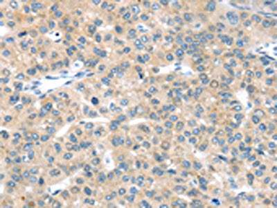 The image on the left is immunohistochemistry of paraffin-embedded Human liver cancer tissue using CSB-PA179150(EPHA2 Antibody) at dilution 1/20, on the right is treated with synthetic peptide. (Original magnification: ×200)