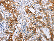 The image on the left is immunohistochemistry of paraffin-embedded Human colon cancer tissue using CSB-PA179189(CA9 Antibody) at dilution 1/50, on the right is treated with fusion protein. (Original magnification: ×200)