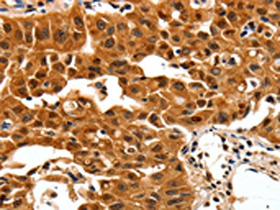 The image on the left is immunohistochemistry of paraffin-embedded Human lung cancer tissue using CSB-PA179192(YWHAB Antibody) at dilution 1/30, on the right is treated with synthetic peptide. (Original magnification: ×200)