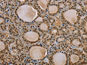 The image on the left is immunohistochemistry of paraffin-embedded Human thyroid cancer tissue using CSB-PA179416(S100A13 Antibody) at dilution 1/35, on the right is treated with synthetic peptide. (Original magnification: ×200)