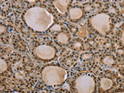 The image on the left is immunohistochemistry of paraffin-embedded Human thyroid cancer tissue using CSB-PA179416(S100A13 Antibody) at dilution 1/35, on the right is treated with synthetic peptide. (Original magnification: ×200)