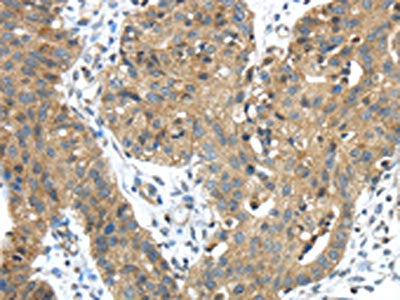 The image on the left is immunohistochemistry of paraffin-embedded Human breast cancer tissue using CSB-PA179468(TMPRSS11E Antibody) at dilution 1/45, on the right is treated with fusion protein. (Original magnification: ×200)