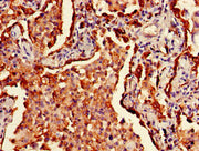 Immunohistochemistry of paraffin-embedded human lung cancer using CSB-PA17949D0Rb at dilution of 1:100