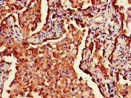 Immunohistochemistry of paraffin-embedded human lung cancer using CSB-PA17949D0Rb at dilution of 1:100