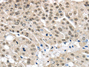 The image on the left is immunohistochemistry of paraffin-embedded Human breast cancer tissue using CSB-PA179506(MED15 Antibody) at dilution 1/30, on the right is treated with fusion protein. (Original magnification: ×200)