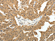 The image on the left is immunohistochemistry of paraffin-embedded Human ovarian cancer tissue using CSB-PA179507(PTCH1 Antibody) at dilution 1/50, on the right is treated with fusion protein. (Original magnification: ×200)