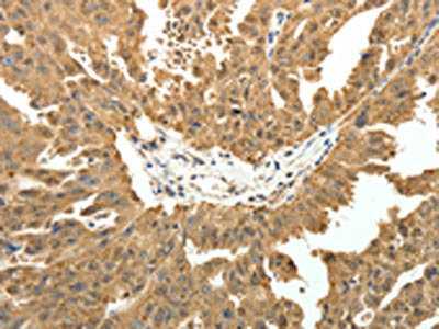 The image on the left is immunohistochemistry of paraffin-embedded Human ovarian cancer tissue using CSB-PA179507(PTCH1 Antibody) at dilution 1/50, on the right is treated with fusion protein. (Original magnification: ×200)