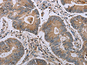 The image on the left is immunohistochemistry of paraffin-embedded Human colon cancer tissue using CSB-PA179571(MAVS Antibody) at dilution 1/20, on the right is treated with synthetic peptide. (Original magnification: ×200)