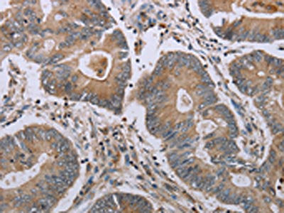 The image on the left is immunohistochemistry of paraffin-embedded Human colon cancer tissue using CSB-PA179571(MAVS Antibody) at dilution 1/20, on the right is treated with synthetic peptide. (Original magnification: ×200)
