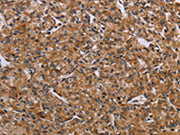The image on the left is immunohistochemistry of paraffin-embedded Human prostate cancer tissue using CSB-PA179611(AATK Antibody) at dilution 1/45, on the right is treated with synthetic peptide. (Original magnification: ×200)