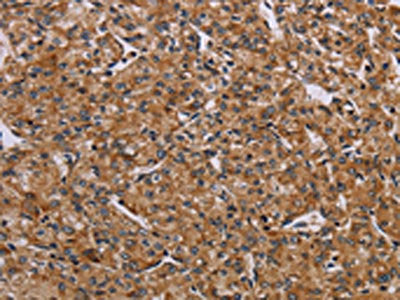 The image on the left is immunohistochemistry of paraffin-embedded Human prostate cancer tissue using CSB-PA179611(AATK Antibody) at dilution 1/45, on the right is treated with synthetic peptide. (Original magnification: ×200)