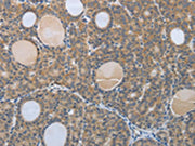 The image on the left is immunohistochemistry of paraffin-embedded Human thyroid cancer tissue using CSB-PA179620(BRAF Antibody) at dilution 1/60, on the right is treated with synthetic peptide. (Original magnification: ×200)