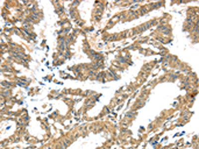 The image on the left is immunohistochemistry of paraffin-embedded Human colon cancer tissue using CSB-PA179693(KCNG3 Antibody) at dilution 1/40, on the right is treated with synthetic peptide. (Original magnification: ×200)