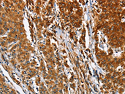 The image on the left is immunohistochemistry of paraffin-embedded Human gastic cancer tissue using CSB-PA179766(BCAP31 Antibody) at dilution 1/30, on the right is treated with fusion protein. (Original magnification: ×200)