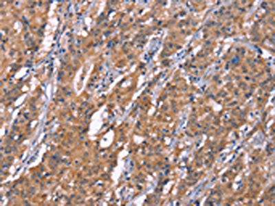 The image on the left is immunohistochemistry of paraffin-embedded Human gastic cancer tissue using CSB-PA179889(HRASLS2 Antibody) at dilution 1/20, on the right is treated with synthetic peptide. (Original magnification: ×200)