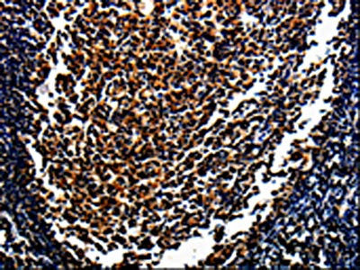 The image on the left is immunohistochemistry of paraffin-embedded Human tonsil tissue using CSB-PA179901(MAGEA4 Antibody) at dilution 1/10, on the right is treated with fusion protein. (Original magnification: ×200)