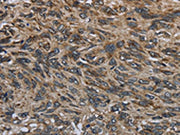 The image on the left is immunohistochemistry of paraffin-embedded Human esophagus cancer tissue using CSB-PA180065(GYPC Antibody) at dilution 1/60, on the right is treated with fusion protein. (Original magnification: ×200)