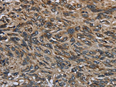 The image on the left is immunohistochemistry of paraffin-embedded Human esophagus cancer tissue using CSB-PA180065(GYPC Antibody) at dilution 1/60, on the right is treated with fusion protein. (Original magnification: ×200)