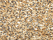 The image on the left is immunohistochemistry of paraffin-embedded Human prostate cancer tissue using CSB-PA180070(SLC6A19 Antibody) at dilution 1/35, on the right is treated with synthetic peptide. (Original magnification: ×200)