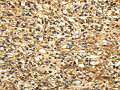 The image on the left is immunohistochemistry of paraffin-embedded Human prostate cancer tissue using CSB-PA180070(SLC6A19 Antibody) at dilution 1/35, on the right is treated with synthetic peptide. (Original magnification: ×200)
