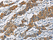The image on the left is immunohistochemistry of paraffin-embedded Human gastic cancer tissue using CSB-PA180077(PIP4K2A Antibody) at dilution 1/40, on the right is treated with fusion protein. (Original magnification: ×200)