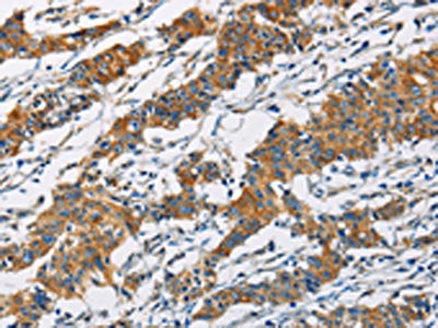 The image on the left is immunohistochemistry of paraffin-embedded Human gastic cancer tissue using CSB-PA180077(PIP4K2A Antibody) at dilution 1/40, on the right is treated with fusion protein. (Original magnification: ×200)